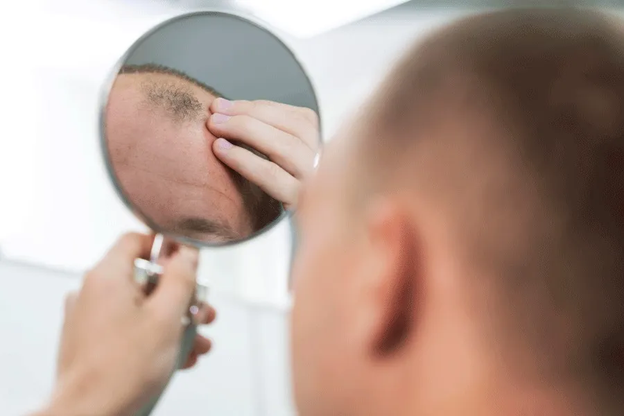 8 Conseils Pour Eviter les Gonflements Après une Greffe de Cheveux