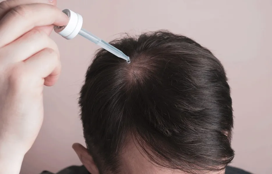 Faut-Il Prendre du Minoxidil Après une Greffe de Cheveux ?