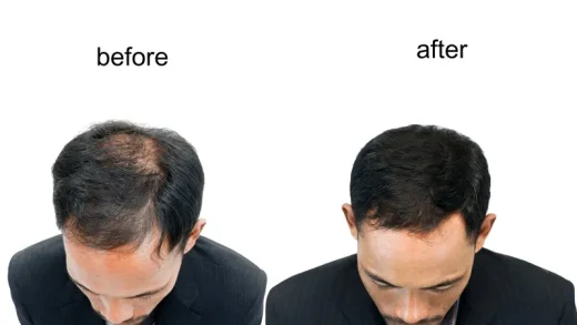 Pour Une Greffe de Cheveux – Les Choses Les Plus Exactes à Savoir
